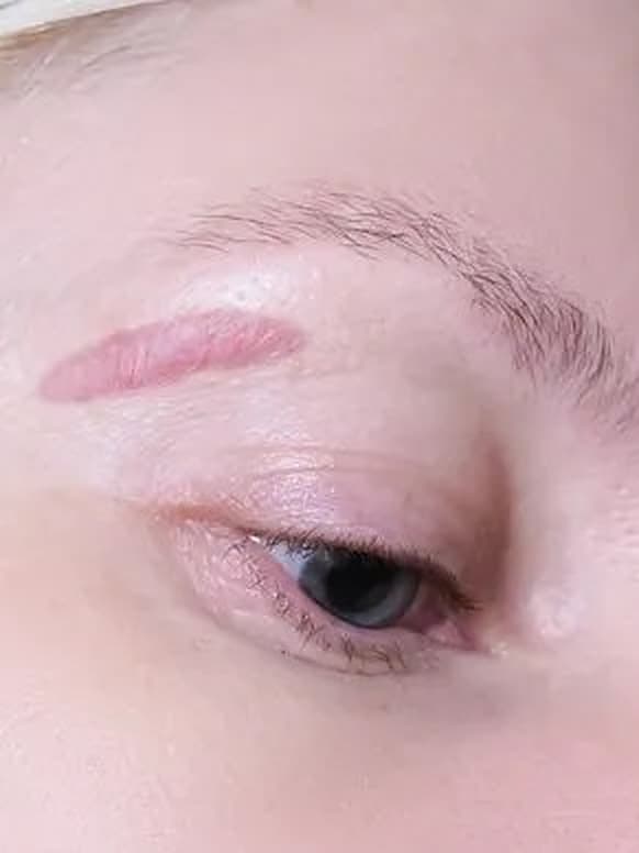 Acne Scars & Surgical Scars treatment at Marie Jé Aesthetics in Sunnyvale