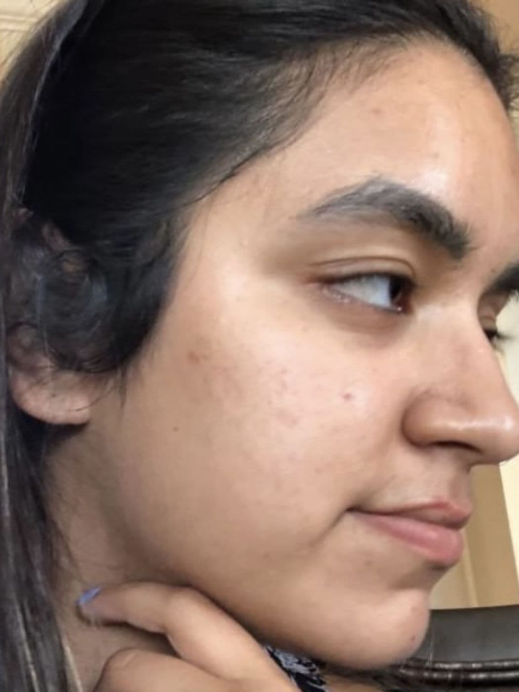 Laser scar treatment, after