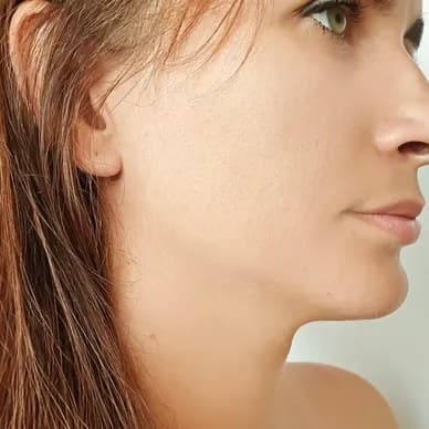 XERF skin tightening, after