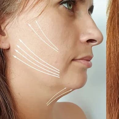 XERF skin tightening, before